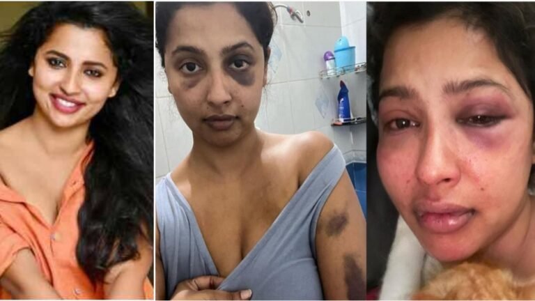 ಬಾಯ್ ಫ್ರೆಂಡ್ ಇಂದ ಹ-ಲ್ಲೆ ಸೋಶಿಯಲ್ ಮೀಡಿಯಾದಲ್ಲಿ ಕಿರುಕುಳ ಕೊಟ್ಟು ದೈಹಿಕವಾಗಿ ಹಿಂ-ಸೆ ಕೊಟ್ಟ ಪೋಟೋಸ್ ಹಂಚಿಕೊಂಡ ನಟಿ ಅನಿಕಾ. ಬಾಯ್ ಫ್ರೆಂಡ್ ಇಂದ ಹ-ಲ್ಲೆ ಸೋಶಿಯಲ್ ಮೀಡಿಯಾದಲ್ಲಿ ಕಿರುಕುಳ ಕೊಟ್ಟು ದೈಹಿಕವಾಗಿ ಹಿಂ-ಸೆ ಕೊಟ್ಟ ಪೋಟೋಸ್ ಹಂಚಿಕೊಂಡ ನಟಿ ಅನಿಕಾ.