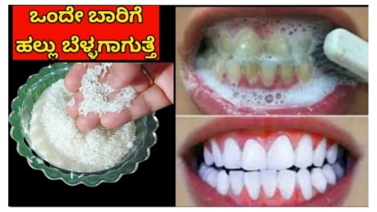 ನಿಮಿಷದಲ್ಲಿ ಎಷ್ಟೇ ಹಳದಿಯಾದ ಪಾಚಿ ಕಟ್ಟಿದ್ದ ಹಲ್ಲು ಬೆಳ್ಳಗಾಗುತ್ತೆ ಹಲ್ಲಿನ ಎಲ್ಲಾ ಸಮಸ್ಯೆಗೆ ಇದು ರಾಮಬಾಣ 100% ಫಲಿತಾಂಶ ನೀಡುತ್ತೆ.!