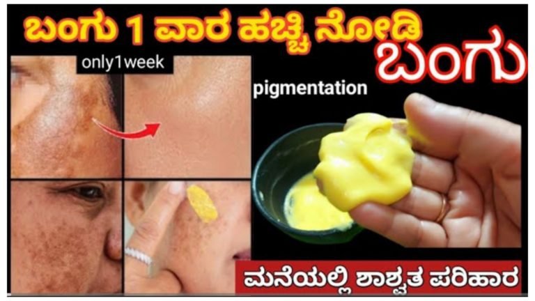 ಒಂದೇ ವಾರದಲ್ಲಿ ಬಂಗು ಕಪ್ಪು ಕಲೆಗಳು ಮಾಯ ಆಗುತ್ತೆ ಈ ಮನೆಮದ್ದು ಬಳಸಿ ಶಾಶ್ವತ ಪರಿಹಾರ.! ಒಂದೇ ವಾರದಲ್ಲಿ ಬಂಗು ಕಪ್ಪು ಕಲೆಗಳು ಮಾಯ ಆಗುತ್ತೆ ಈ ಮನೆಮದ್ದು ಬಳಸಿ ಶಾಶ್ವತ ಪರಿಹಾರ.!