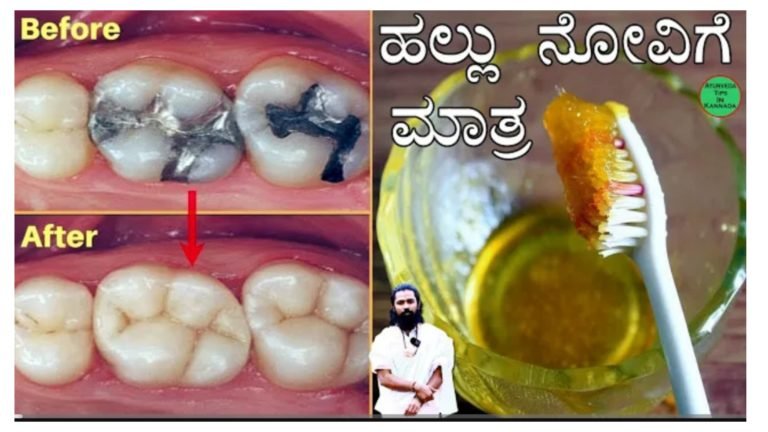 ಹಲ್ಲು ನೋವಿಗೆ ಮನೆಮದ್ದು……….||