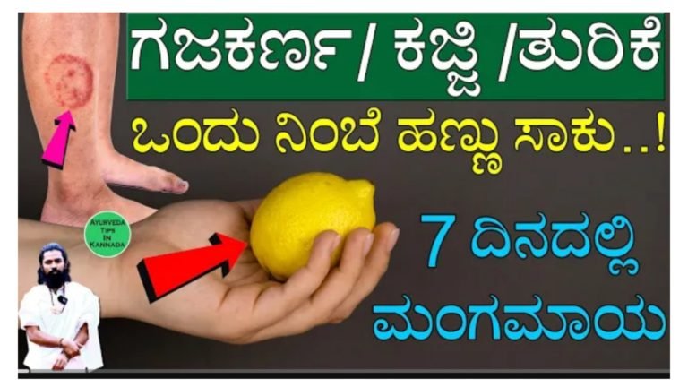 ಗಜಕರ್ಣ // ಕಜ್ಜಿ // ತುರಿಕೆಗೆ // ಚರ್ಮಕ್ಕೆ ಸಂಬಂಧಿಸಿದ ಎಲ್ಲಾ ಸಮಸ್ಯೆಗೂ ಪರಿಹಾರ.!