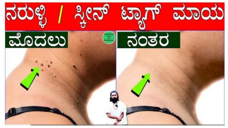 ಸ್ಕಿನ್ ಟ್ಯಾಗ್ಸ್, ನರ ಹುಲಿಗೆ ಮನೆ ಮದ್ದು.! ಸ್ಕಿನ್ ಟ್ಯಾಗ್ಸ್, ನರ ಹುಲಿಗೆ ಮನೆ ಮದ್ದು.!