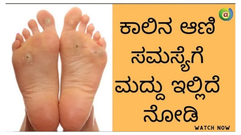 ಕಾಲಿನ ಆಣಿಗೆ ಸುಲಭ ಮನೆ ಮದ್ದು, ಹೀಗೆ ಮಾಡಿ ಆಣಿ ನಿವಾರಣೆಯಾಗುತ್ತದೆ.!