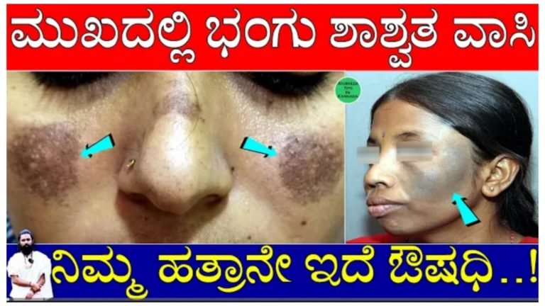 ಮುಖದಲ್ಲಿನ ಭಂಗು ವಾಸಿಯಾಗಲು ಔಷಧಿ ಇದ್ದೇ ಇದೆ, ನಿಮ್ಮ ಮನೆಯಲ್ಲಿರುವ ವಸ್ತುವನ್ನೇ ಬಳಸಿ 21 ದಿನಗಳಲ್ಲಿ ಸಮಸ್ಯೆಯಿಂದ ಹೊರಬನ್ನಿ.!