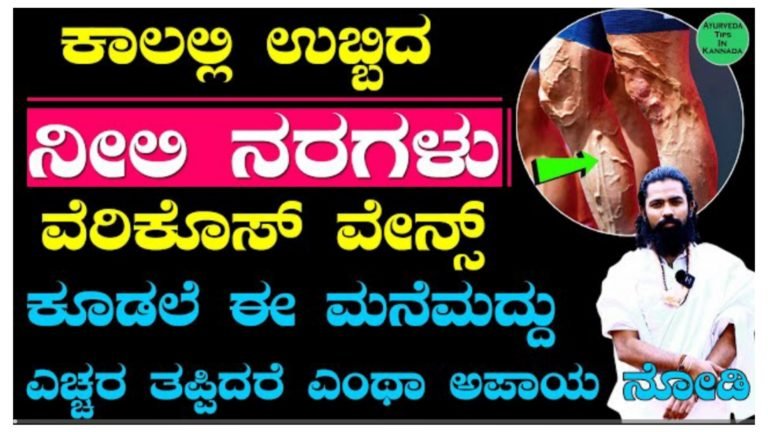 ರಕ್ತನಾಳಗಳ ಉಬ್ಬುವಿಕೆ (ವೆರಿಕೋಸ್ ವೇನ್ಸ್), ನೀಲಿ ನರಗಳ ಬಗ್ಗೆ ಎಚ್ಚರ ತಪ್ಪಿದ್ದರೆ ಎಂತಹ ಅ’ಪಾ’ಯ ಗೊತ್ತಾ? ಈ ಸಮಸ್ಯೆಗಳನ್ನು ಸುಲಭವಾಗಿ ಗುಣಪಡಿಸುವ ಮನೆಮದ್ದು ಇದು.!