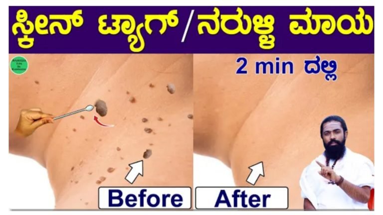 ನರುಳ್ಳಿ, ಸ್ಕಿನ್ ಟ್ಯಾಗ್ ಗುಣಮಾಡುವ ಅದ್ಭುತ ಮನೆಮದ್ದು ಇದು.!