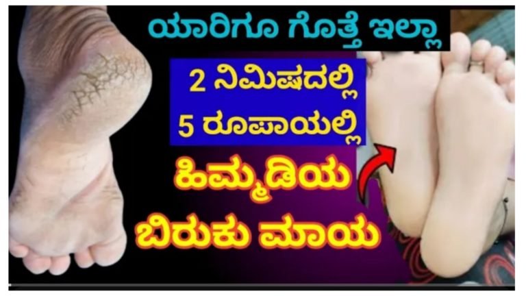 ಹಿಮ್ಮಡಿ ಎಷ್ಟೇ ಒಡೆದು ಚುರಾಗಿದ್ದರು ಕೇವಲ ಒಂದೇ ದಿನ ಹಚ್ಚಿ ಸಾಕು……..!! ಹಿಮ್ಮಡಿಯ ಬಿರುಕು ಮಾಯ….!!