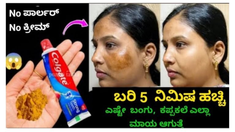 ಬಂಗಿಗೆ ನೋ ಕ್ರೀಮ್ ನೋ ಪಾರ್ಲರ್ ಮನೆಮದ್ದು ಮಾಡಿ ವರುಷಳಿಂದ ಇರುವ ಬಂಗು ಕಪ್ಪುಕಲೆ ಮಾಯಾ ಆಗುತ್ತೆ.! ಬಂಗಿಗೆ ನೋ ಕ್ರೀಮ್ ನೋ ಪಾರ್ಲರ್ ಮನೆಮದ್ದು ಮಾಡಿ ವರುಷಳಿಂದ ಇರುವ ಬಂಗು ಕಪ್ಪುಕಲೆ ಮಾಯಾ ಆಗುತ್ತೆ.!